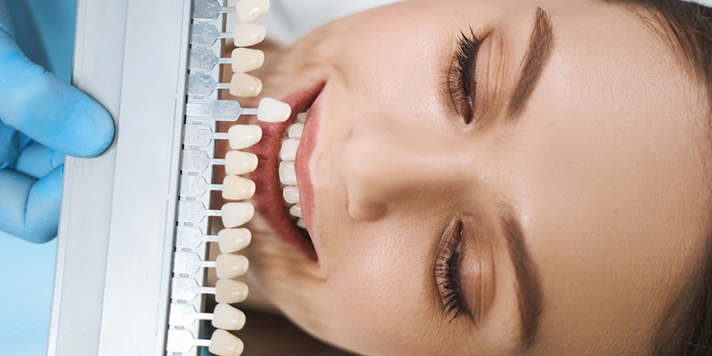 Dental Veneers: Who is a Good Candidate?