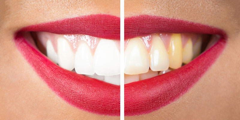 Teeth Whitening: What are the Options?
