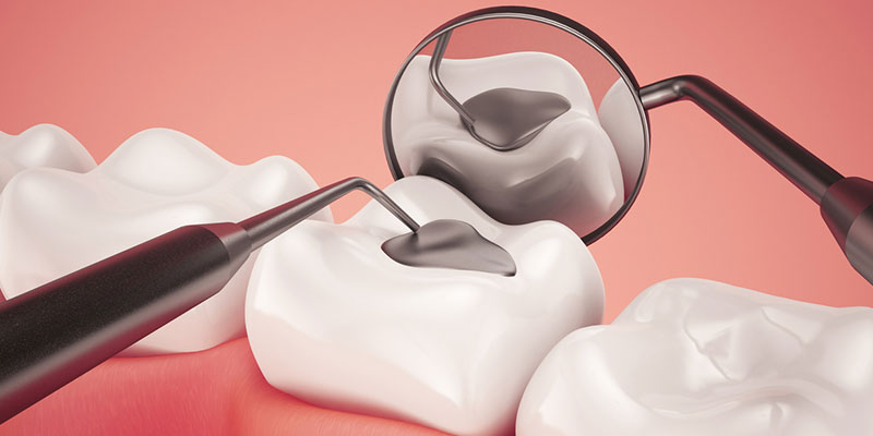 Why Cavity Fillings are Necessary