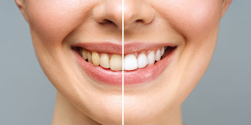 How Professional Tooth Whitening Can Improve Your Smile