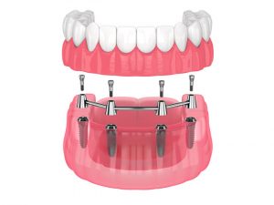 Different Types of Dentures Available