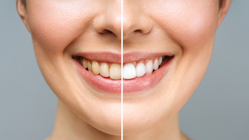 Common Myths About Teeth Whitening Treatments