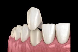How Dental Veneers Are Applied